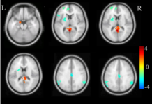 Brain scans help shed light on the PTSD brain, but they cannot diagnose PTSD