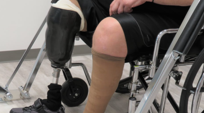 Diabetic foot wounds kill millions, but high-tech solutions and teamwork are making a difference