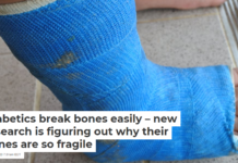 Diabetics break bones easily – new research is figuring out why their bones are so fragile