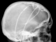 It’s not my fault, my brain implant made me do it