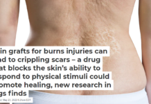 Skin grafts for burns injuries can lead to crippling scars – a drug that blocks the skin’s ability to respond to physical stimuli could promote healing, new research in pigs finds