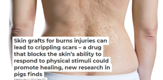 Skin grafts for burns injuries can lead to crippling scars – a drug that blocks the skin’s ability to respond to physical stimuli could promote healing, new research in pigs finds