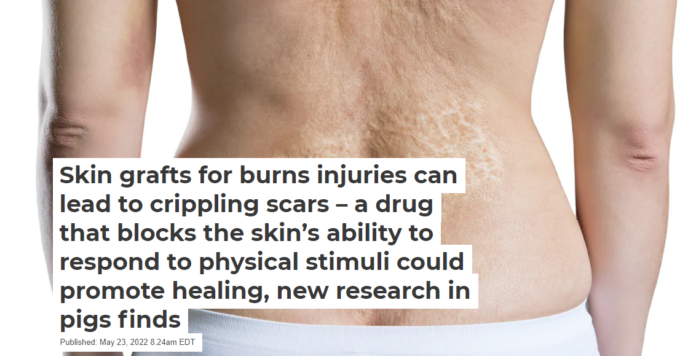 Burn injuries can lead to disfiguring and sometimes crippling scars. Staras/iStock via Getty Images