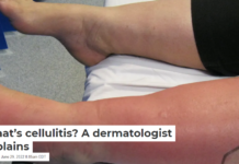 What’s cellulitis? A dermatologist explains