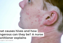 What causes hives and how dangerous can they be? A nurse practitioner explains