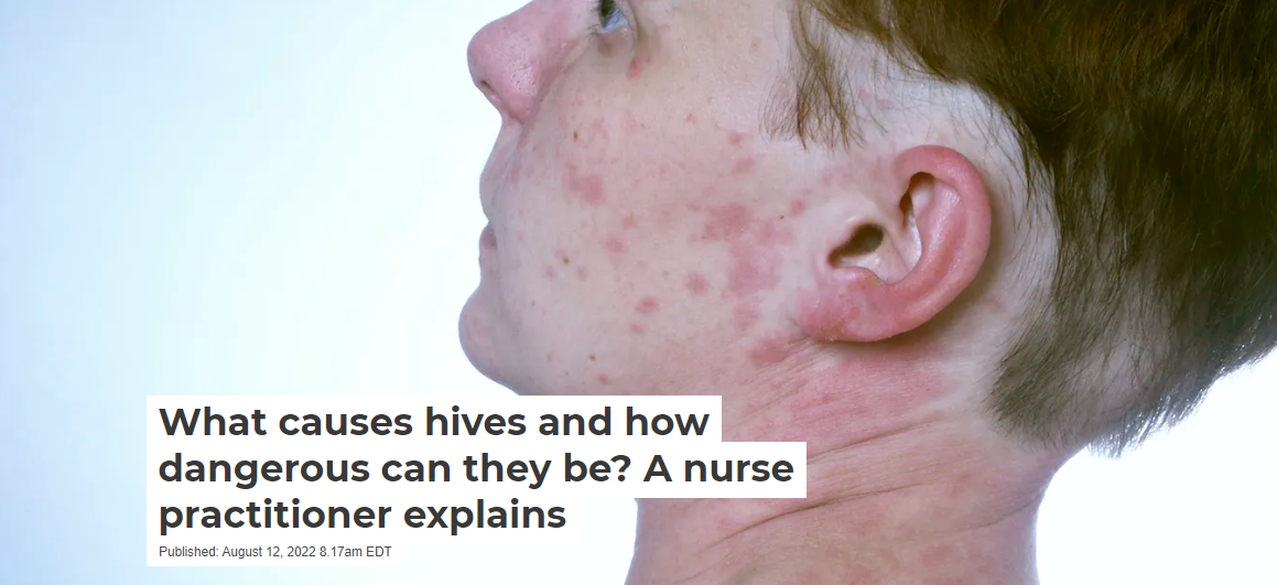 What causes hives and how dangerous can they be? A nurse practitioner