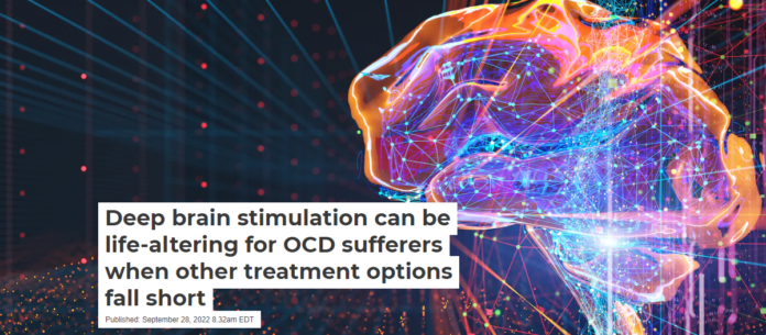 Deep brain stimulation relies on thin electrodes implanted deep in the brain that deliver electrical currents. Olemedia/E+ via Getty Images