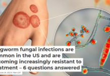 Ringworm fungal infections are common in the US and are becoming increasingly resistant to treatment – 6 questions answered