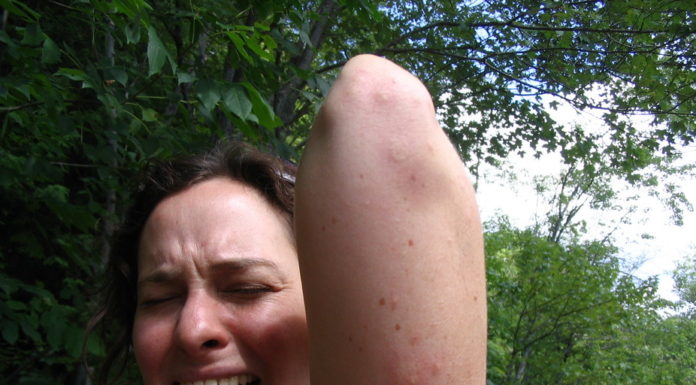 Health Check: why mosquitoes seem to bite some people more